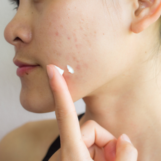 Adult Acne and Aging: Why They Weirdly Go Together