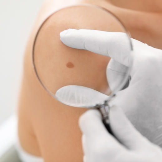 Are You High-Risk for Melanoma? How to Know and What to Do