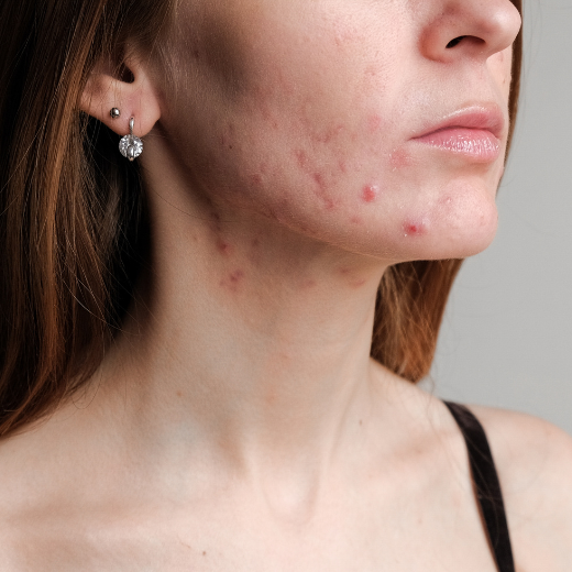Stopping Birth Control? Here's How To Manage Post-Pill Acne