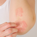 Ditch the Itch: Psoriasis Skin Care Tips