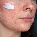 Why Am I Blushing? Common Rosacea Triggers and How to Minimize Them