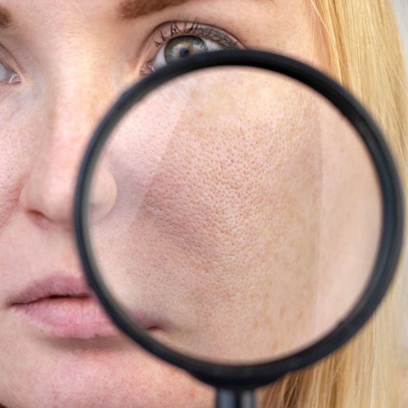 Clogged Pores