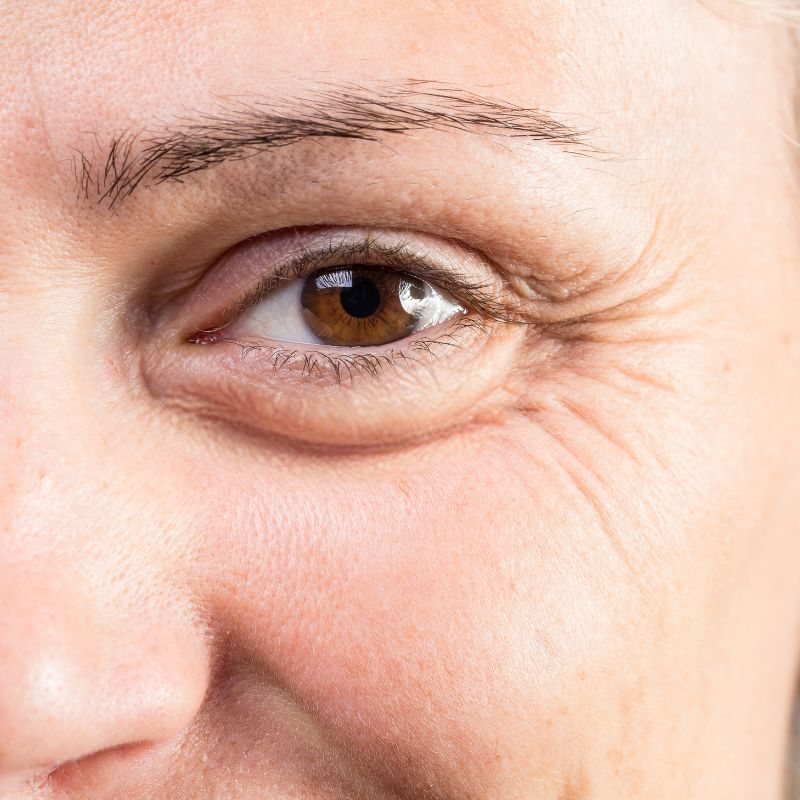 Dark Circles & Puffiness
