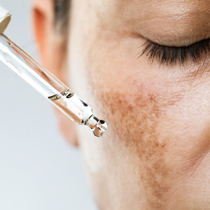 Dark Spots / Melasma
