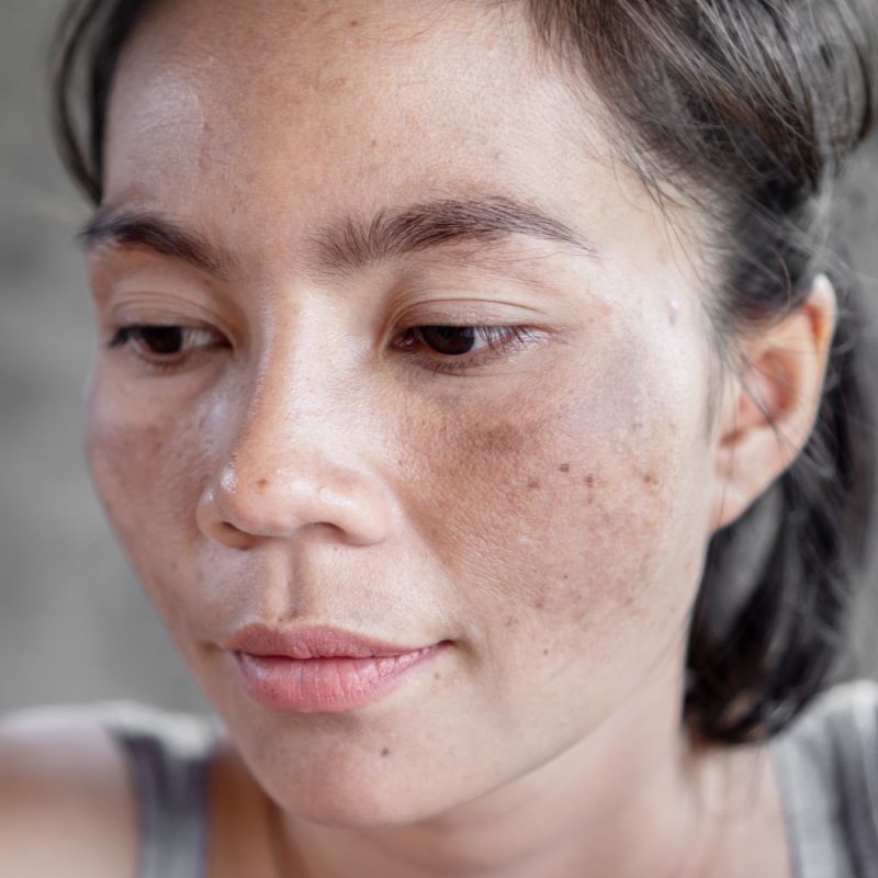Sun Damage