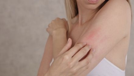 Eczema
