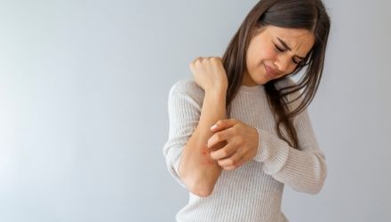 Psoriasis