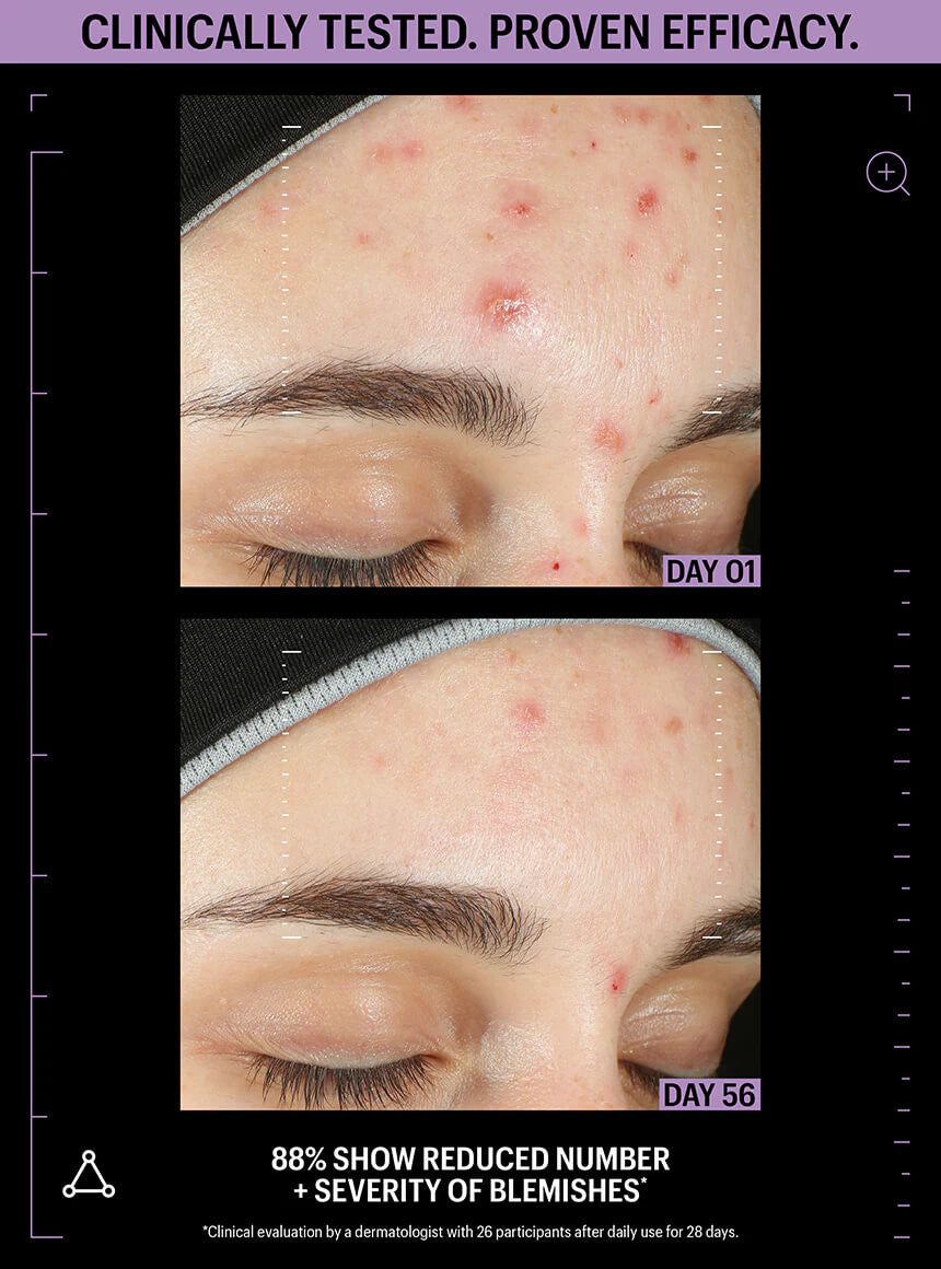 Allies of Skin Azelaic & Kojic Advanced Clarifying Serum 1 fl oz - SkinElite - before & after 1