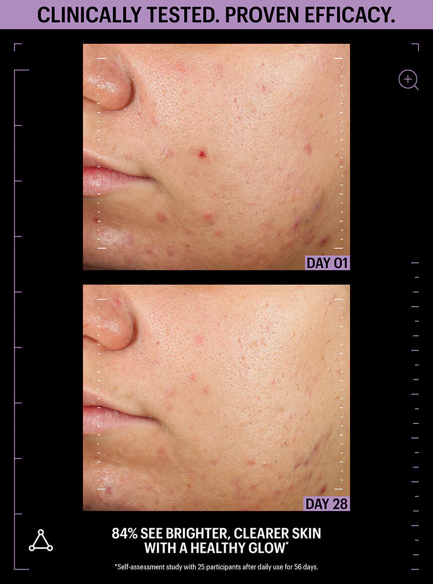 Allies of Skin Azelaic & Kojic Advanced Clarifying Serum 1 fl oz - SkinElite - before & after 2