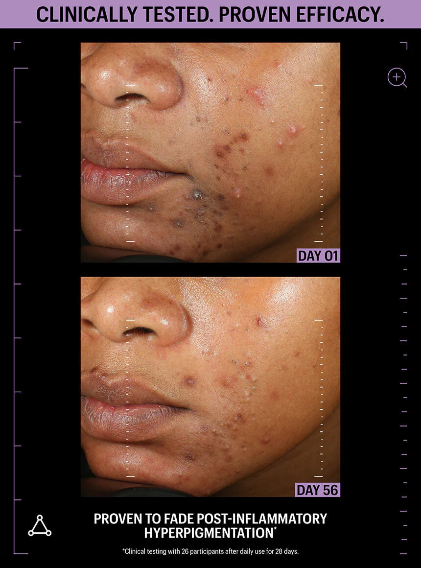 Allies of Skin Azelaic & Kojic Advanced Clarifying Serum 1 fl oz - SkinElite - before & after 3
