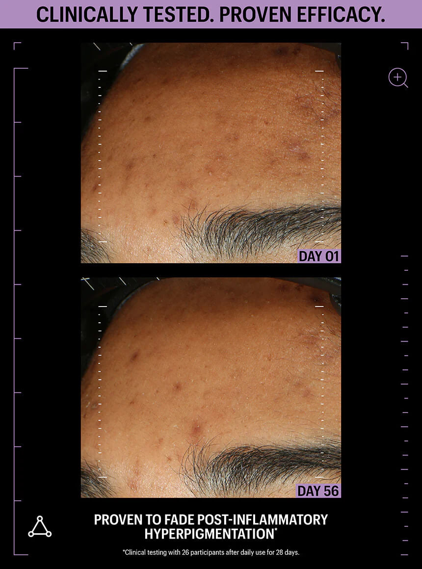 Allies of Skin Azelaic & Kojic Advanced Clarifying Serum 1 fl oz - SkinElite - before & after 4