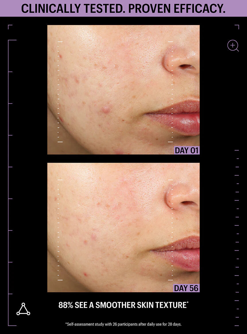 Allies of Skin Azelaic & Kojic Advanced Clarifying Serum 1 fl oz - SkinElite - before & after 5