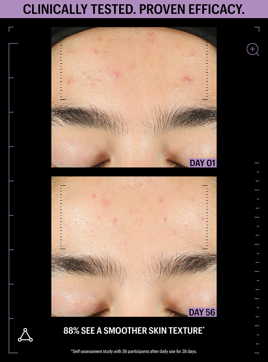 Allies of Ski6 Azelaic & Kojic Advanced Clarifying Serum 1 fl oz - SkinElite - before & after 1