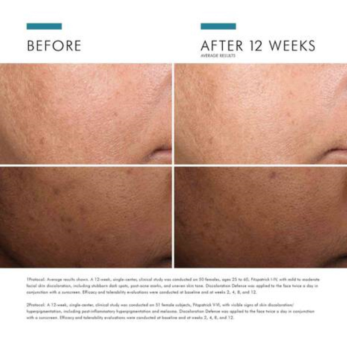 SkinCeuticals Discoloration Defense 1 fl oz - SkinElite - before and after
