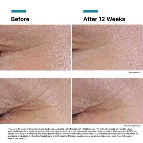 SkinCeuticals P-TIOX 1 fl oz - SkinElite - results