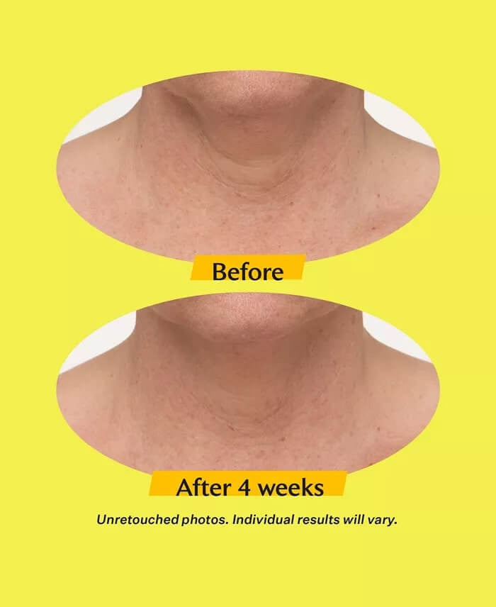 StriVectin Get Lifted Kit - Set of 2 - SkinElite - before and after