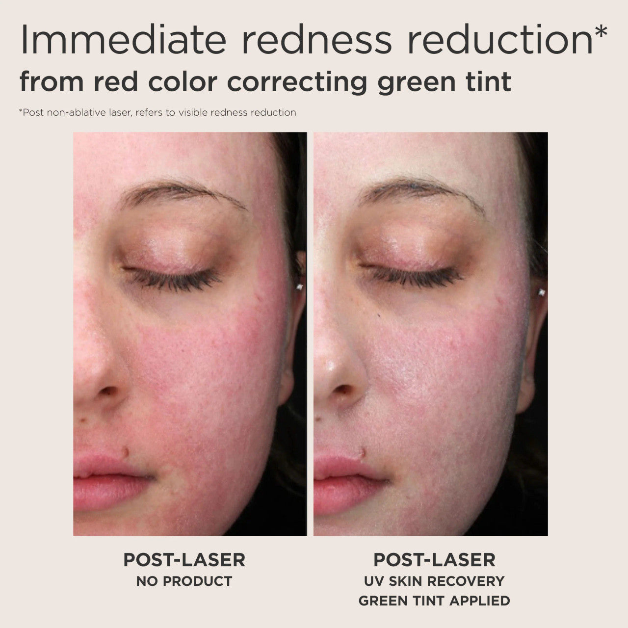EltaMD UV Skin Recovery Green Tint Sunscreen Before and After Showing Immediate Redness Reduction