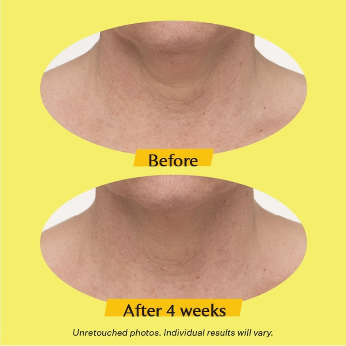StriVectin TL Advanced™ Tightening Neck Cream PLUS 1.7 oz - SkinElite - results neck 1