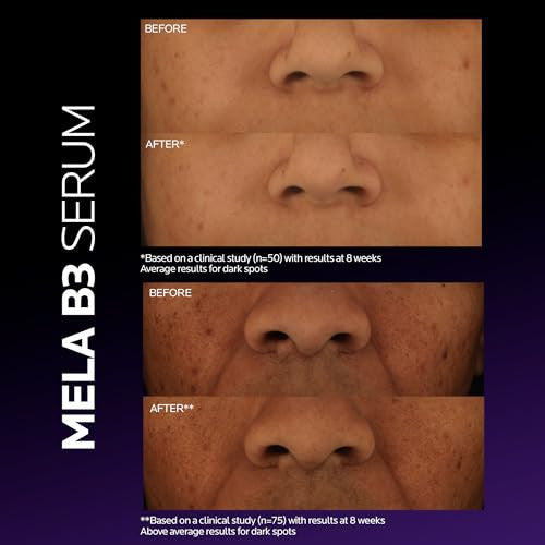 La Roche-Posay Mela B3 Serum 1 fl oz - SkinElite - before and after