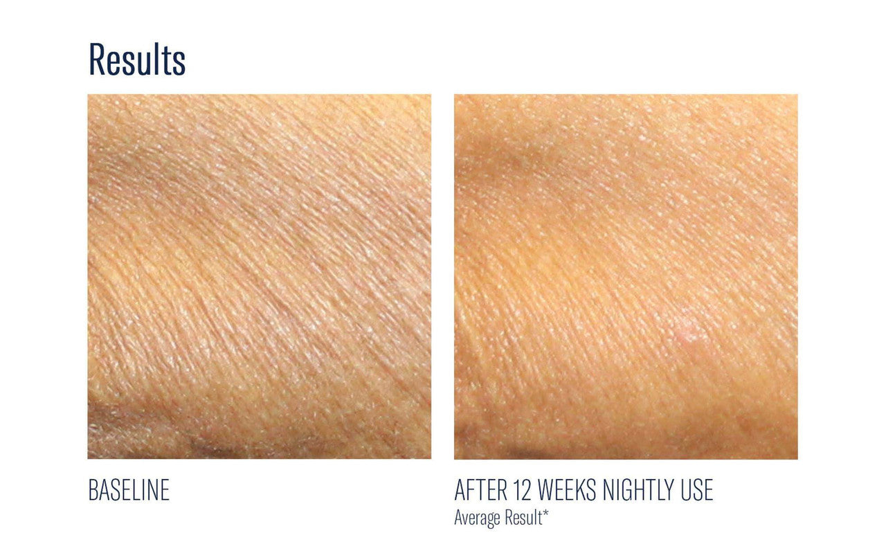 SkinBetter Science AlphaRet Body Overnight Cream 5 fl oz - SkinElite - before and after 2