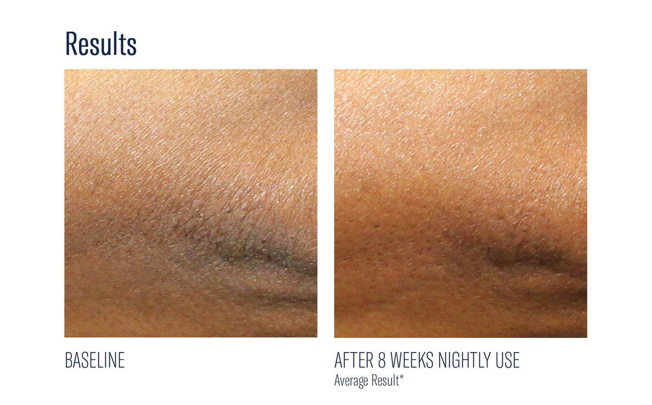 SkinBetter Science AlphaRet Body Overnight Cream 5 fl oz - SkinElite - before and after 1