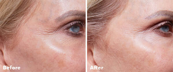 AnteAGE® Home Microneedling Intro Kit - SkinElite - before and after 2