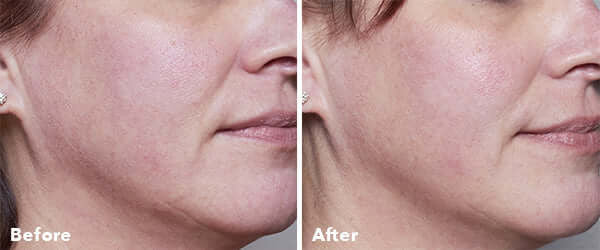 AnteAGE® Home Microneedling Intro Kit - SkinElite - before and after 1