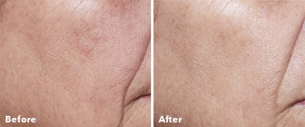 AnteAGE® Home Microneedling Intro Kit - SkinElite - before and after 3
