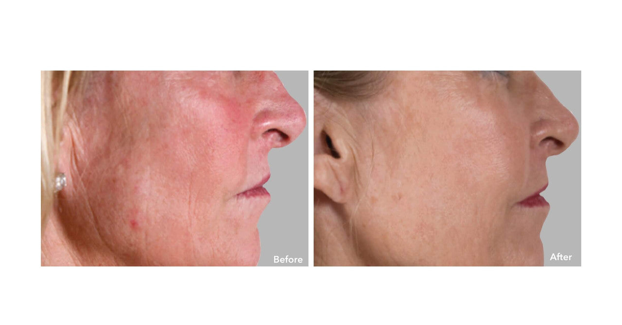 AnteAGE MD Biosome System Before and After Example 1 - Skin Elite