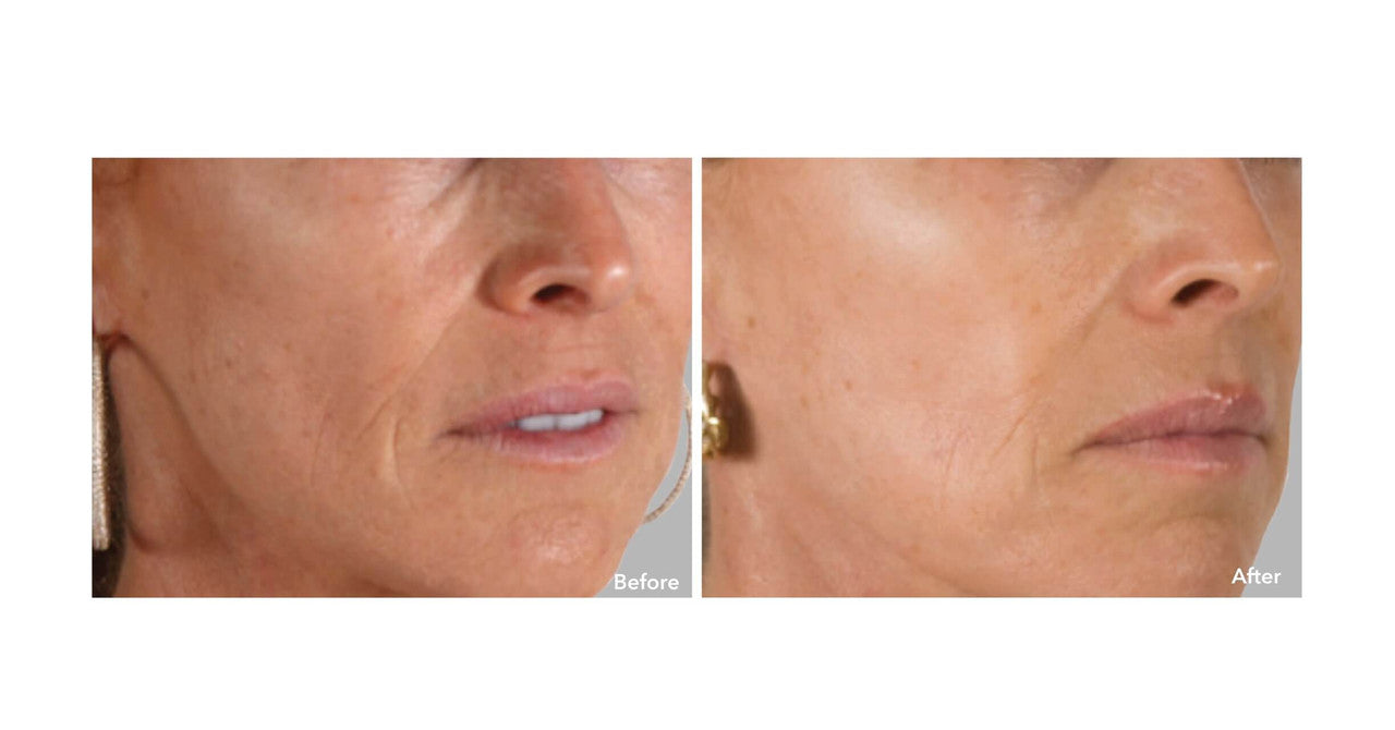 AnteAGE MD Biosome System Before and After Example 2 - Skin Elite