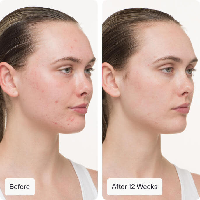 Nutrafol Clear Skin Nutraceutical - Women - 120 capsules - SkinElite - before and after