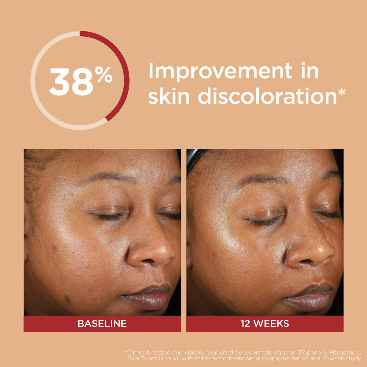 EltaMD UV Clear Deep Tinted Broad-Spectrum SPF 46 - 1.7 fl oz - SkinElite - improves discoloration