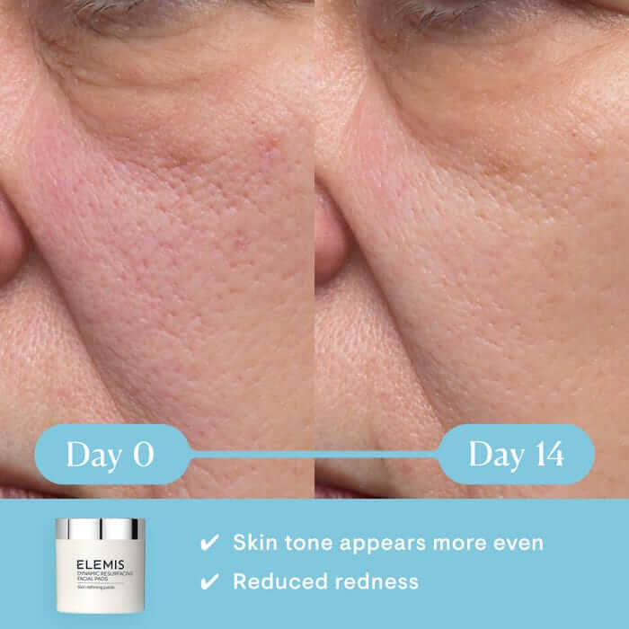 Elemis Dynamic Resurfacing Facial Pads - 60 pads - SkinElite - before and after