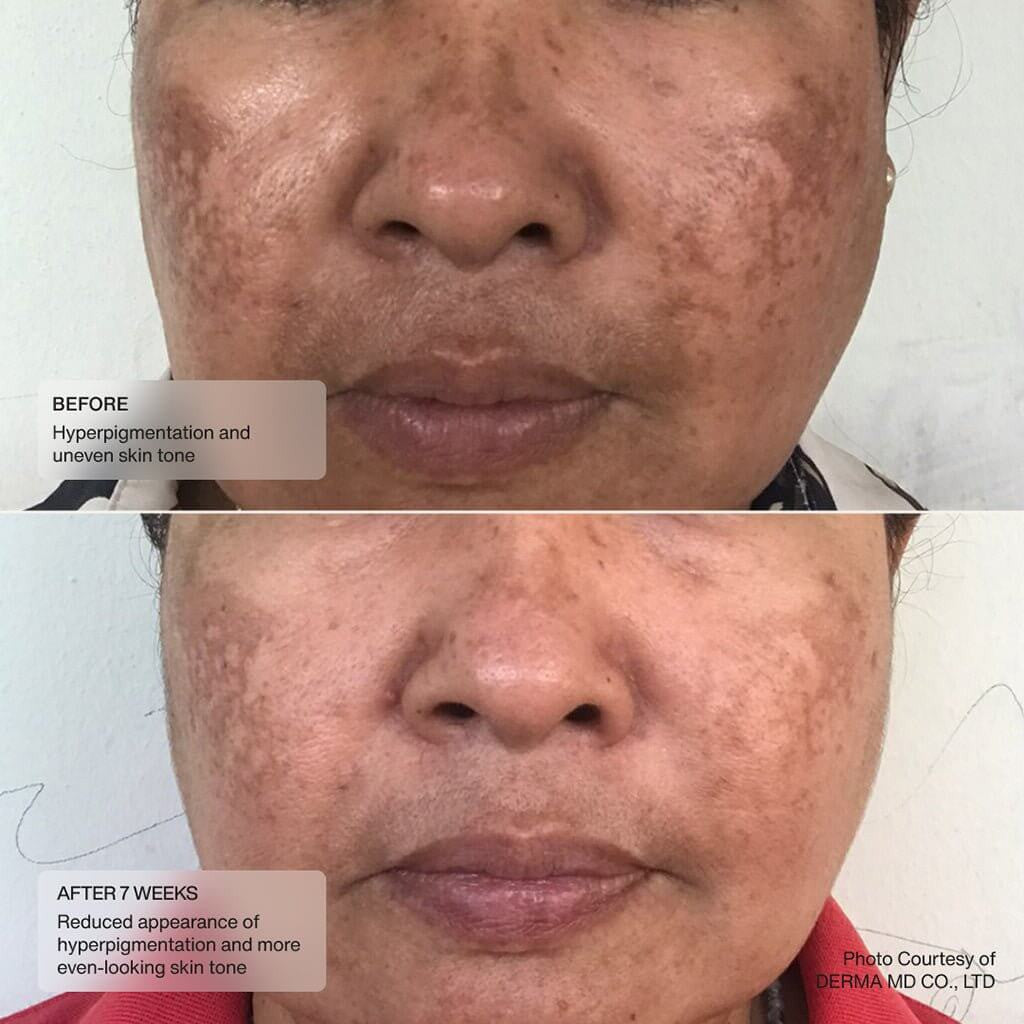 Senté Even Tone Retinol Cream 1 fl oz - SkinElite- before and after 2