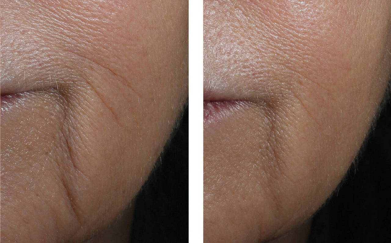 SkinBetter Science InterFuse Intensive Treatment LINES 1 fl oz - SkinElite - before and after 2