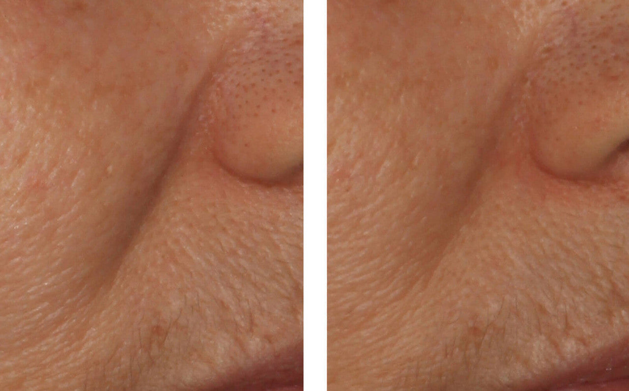 SkinBetter Science InterFuse Intensive Treatment LINES 1 fl oz - SkinElite - before and after 1