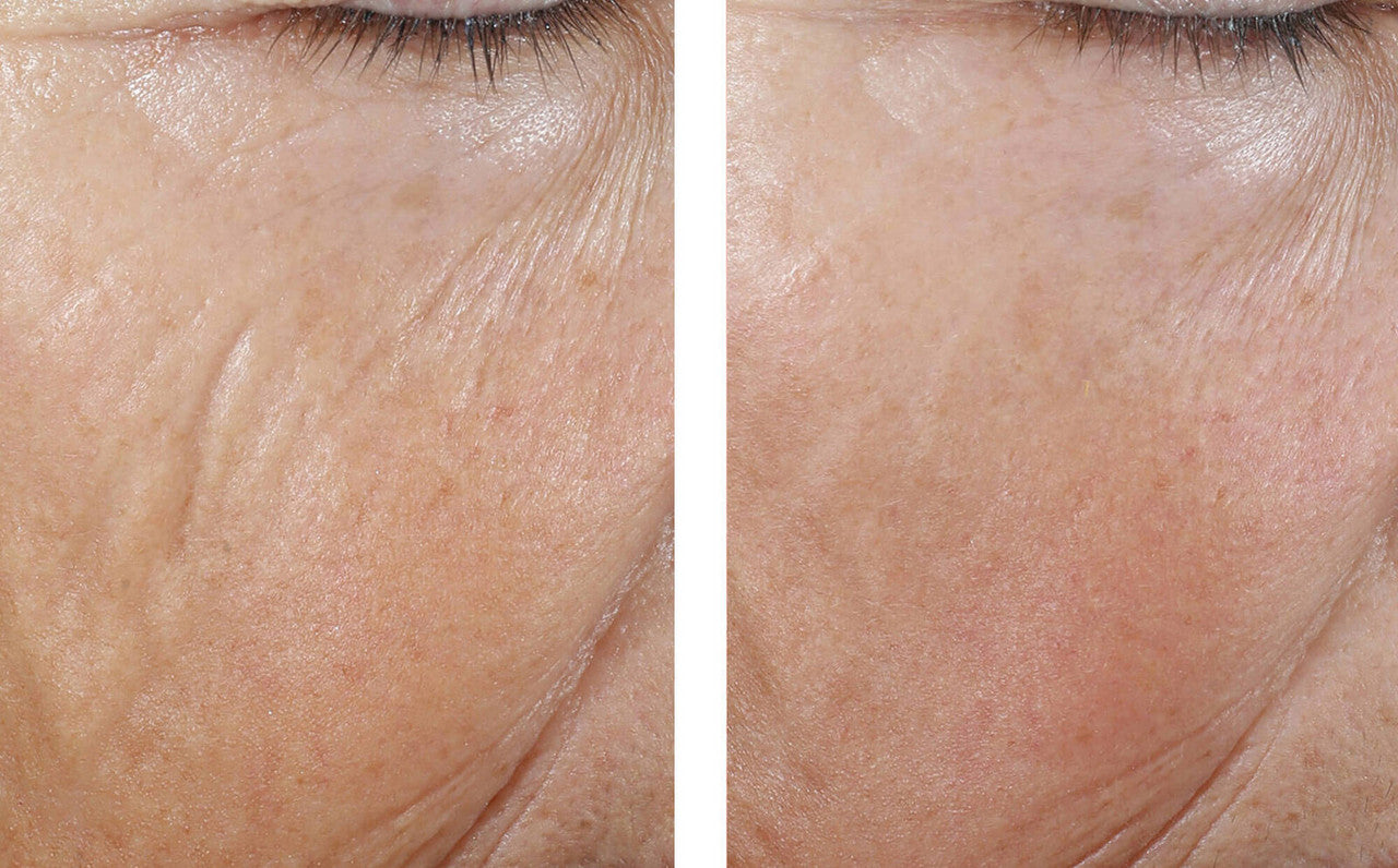 SkinBetter Science InterFuse Intensive Treatment LINES 1 fl oz - SkinElite - before and after 3