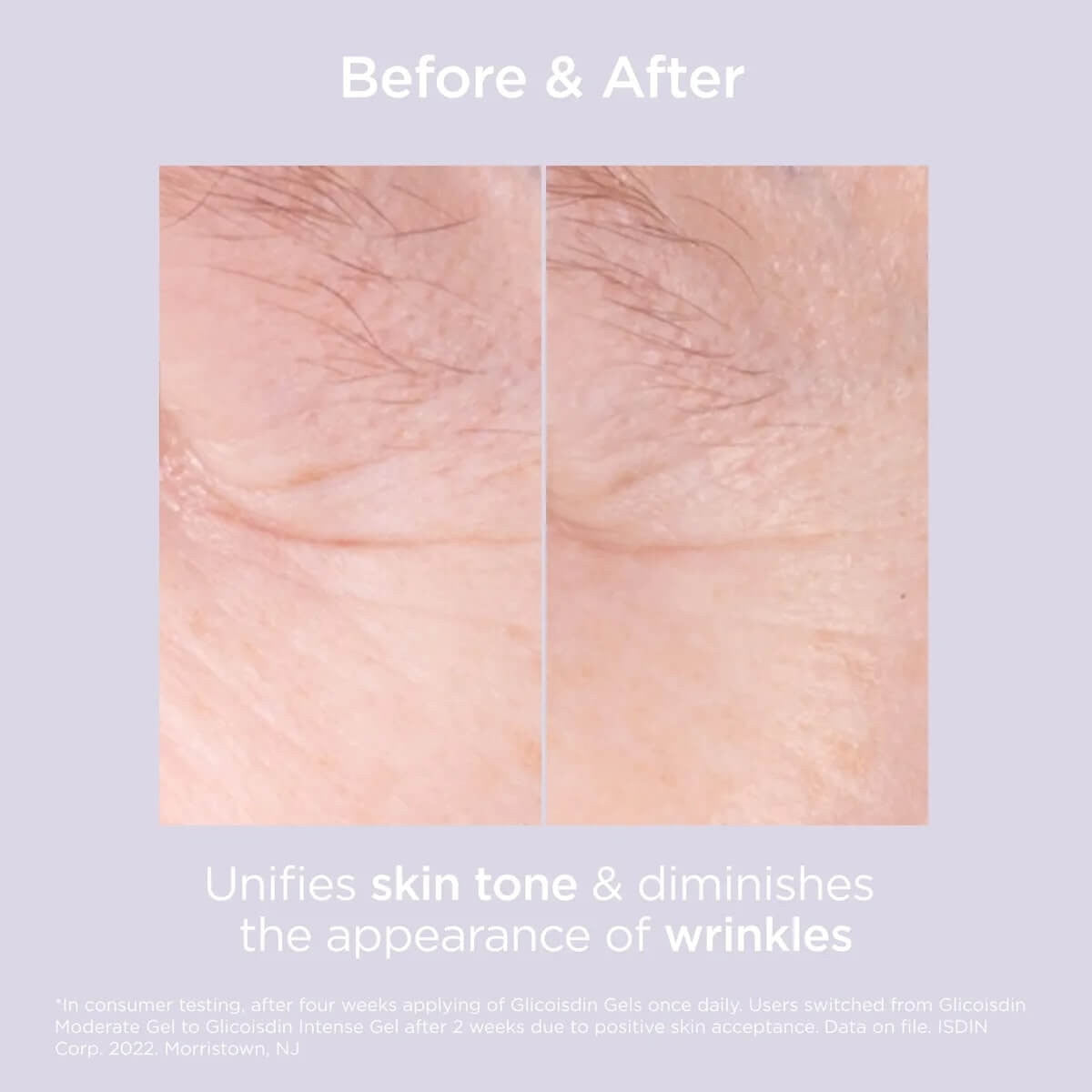 ISDIN Isdinceutics Glicoisdin® 15 Moderate Gel 1.76 oz - SkinElite - before and after