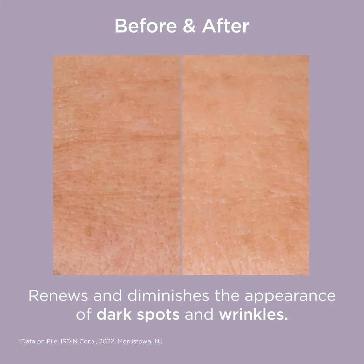 ISDIN Isdinceutics Glicoisdin® 25 Intense Gel 1.76 oz - SkinElite - before and after 