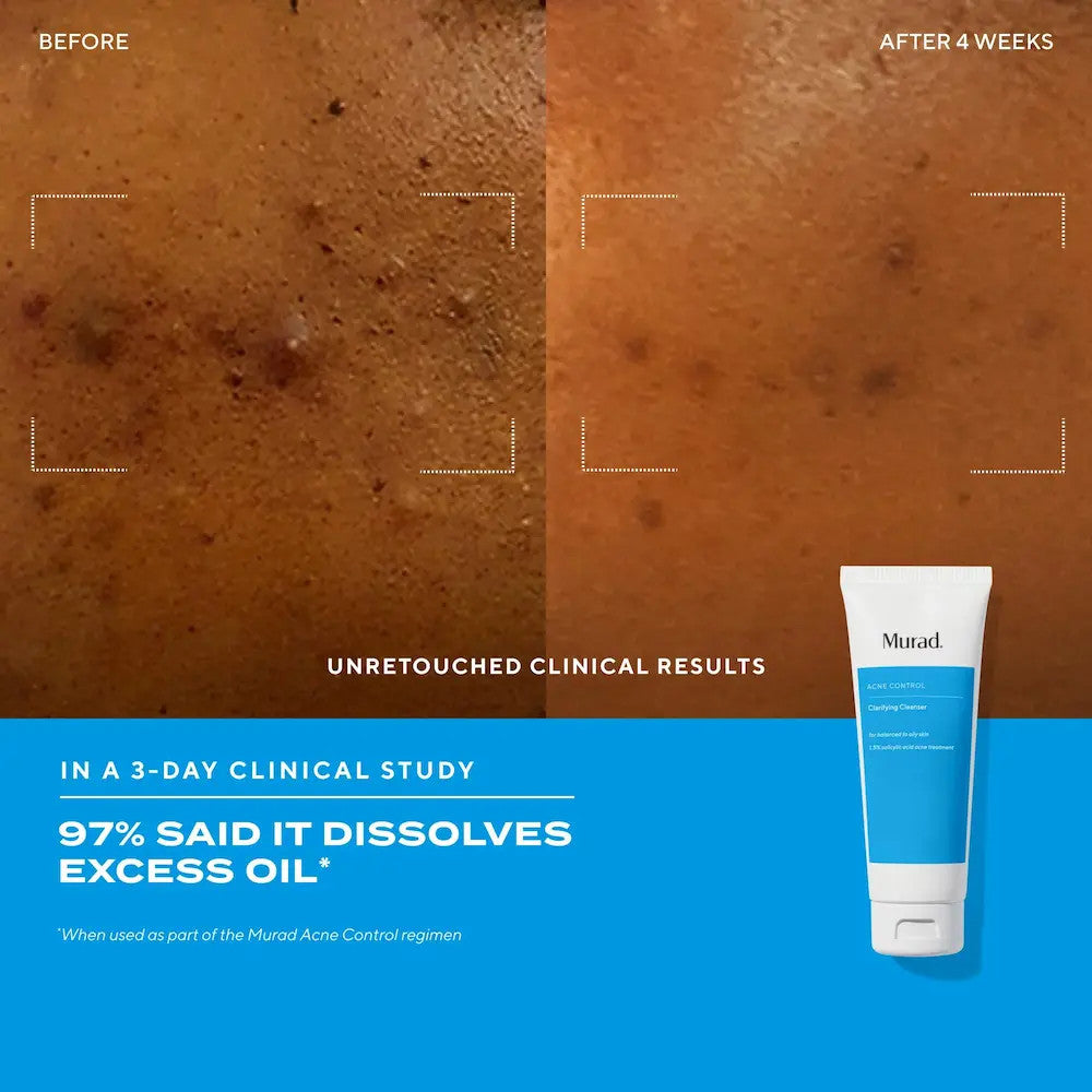 Murad Clear Skin Acne Discovery kit before and after 1