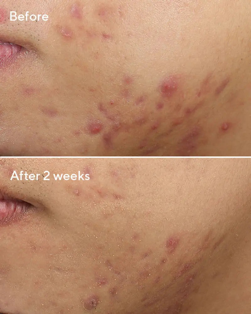 Murad Deep Relief Acne Treatment - results