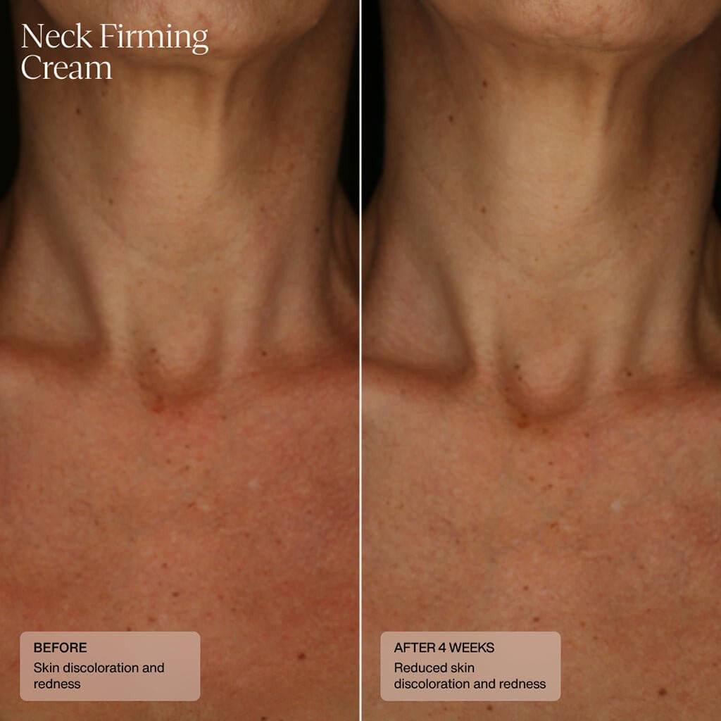 Senté Neck Firming Cream 1.7 fl oz - SkinElite - before and after 1