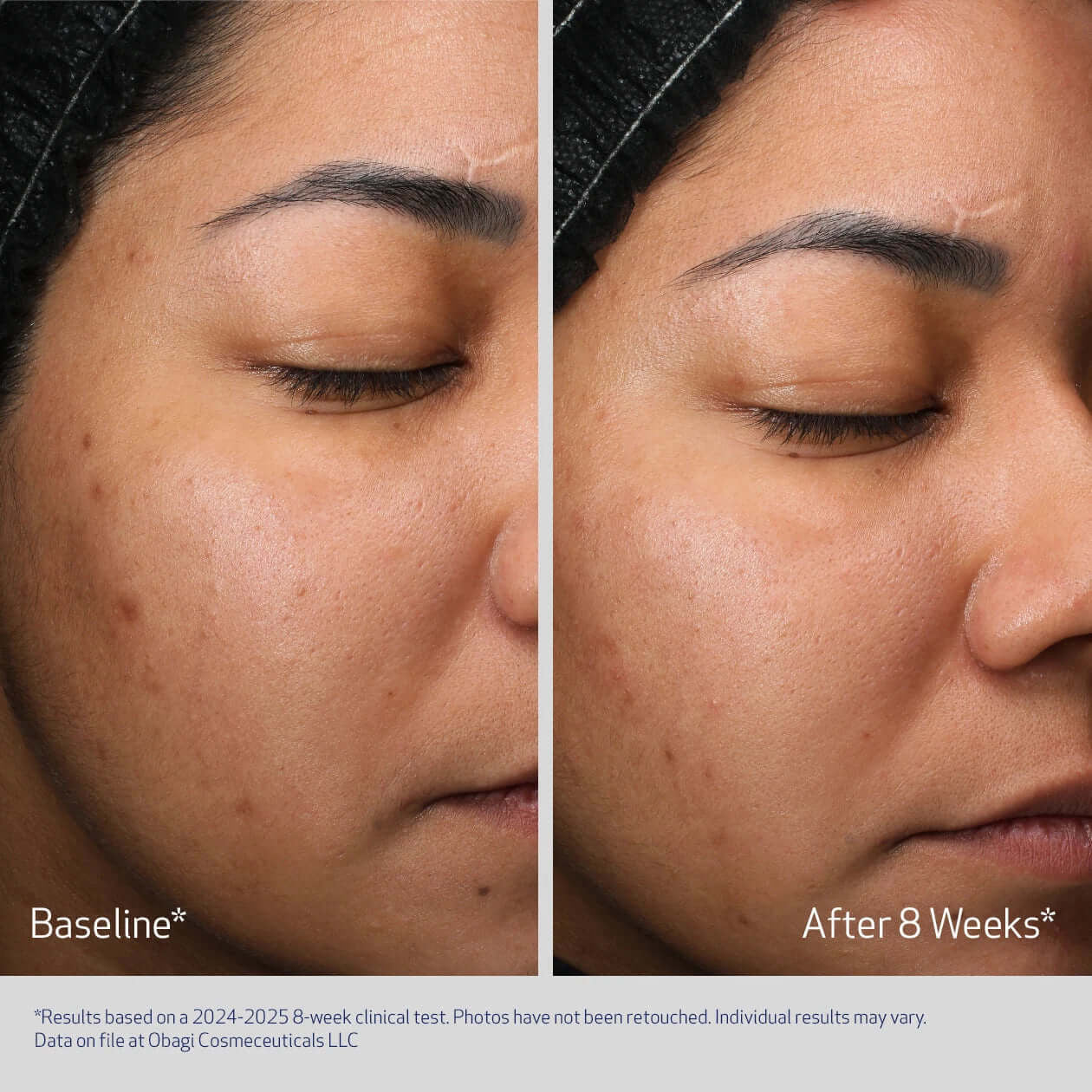 Obagi Retinol + PHA Refining Night Cream 1.7 fl oz - SkinElite - before and after 1