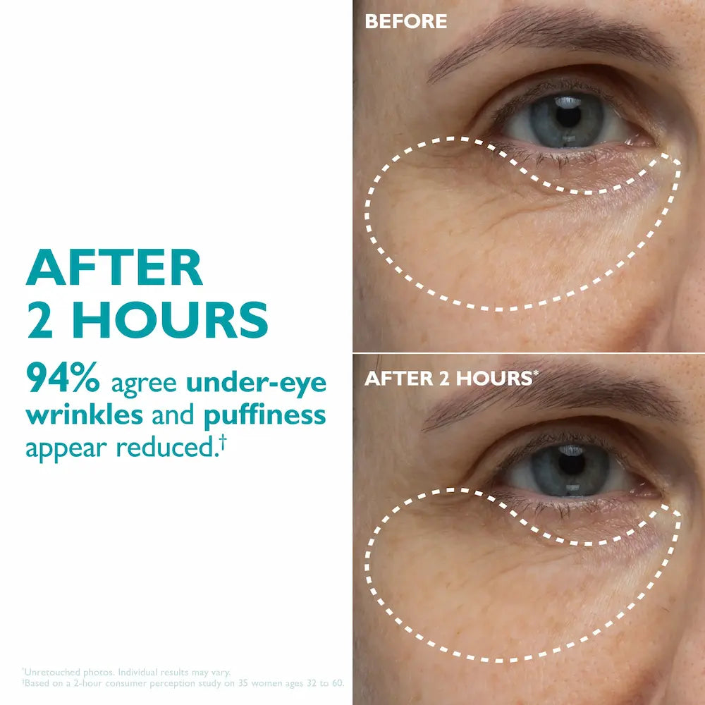 Peter Thomas Roth Peptide Skinjection Peptide Infused Face + Eye Tape before and after eyes