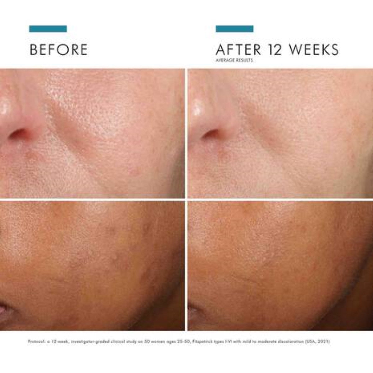 SkinCeuticals Phloretin CF 1 fl oz - SkinElite - before and after