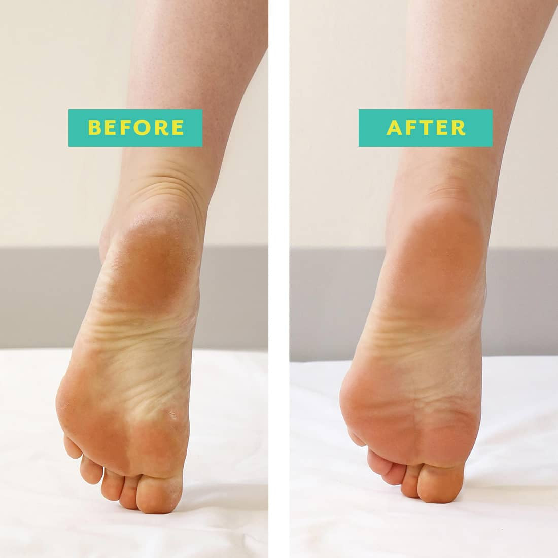 Patchology POSHPEEL™ Pedi Cure - Single Use - SkinElite - before and after