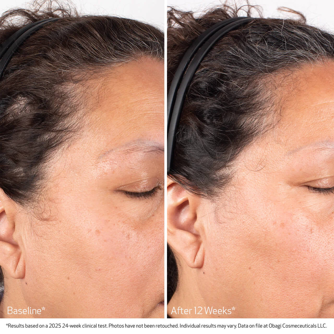 Obagi BIOSTIM™ Scalp Serum 2 fl oz - Skin Elite - Clinical Results 1