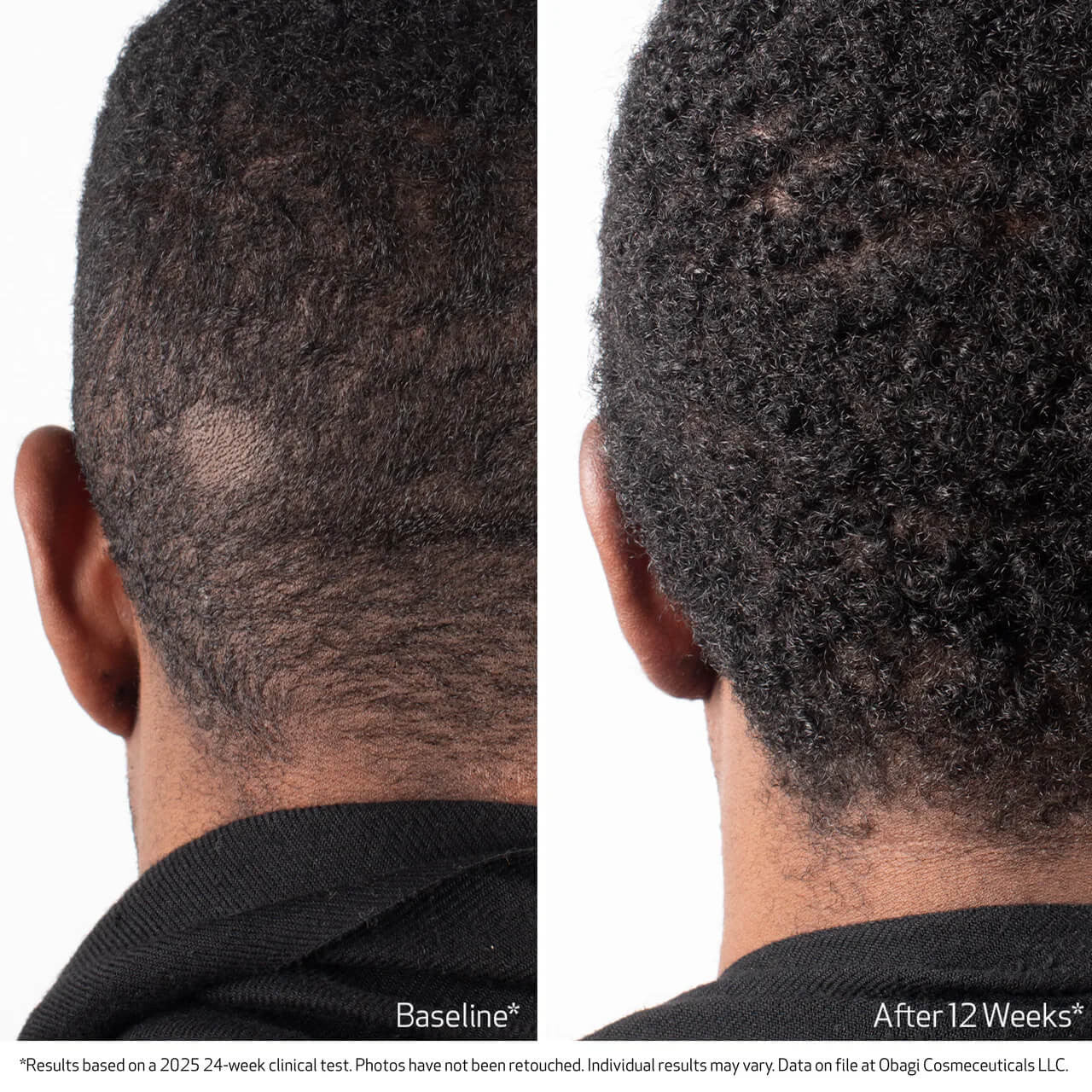 Obagi BIOSTIM™ Scalp Serum 2 fl oz - Skin Elite - Clinical Results 2