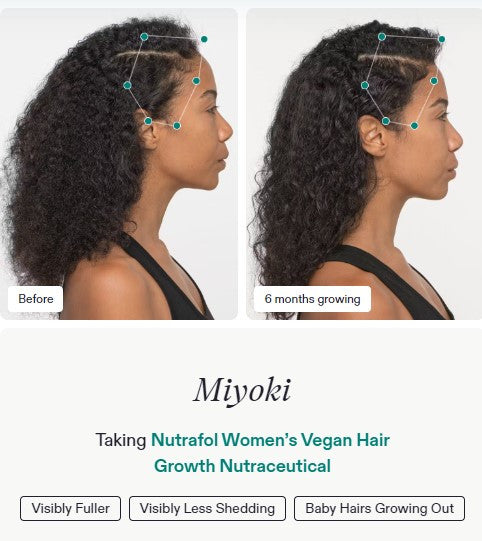 Nutrafol Women's Vegan - Hair Growth Nutraceutical - 120 capsules - SkinElite - before and after
