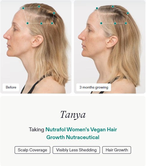 Nutrafol Women's Vegan - Hair Growth Nutraceutical - 120 capsules - SkinElite - before and after 2